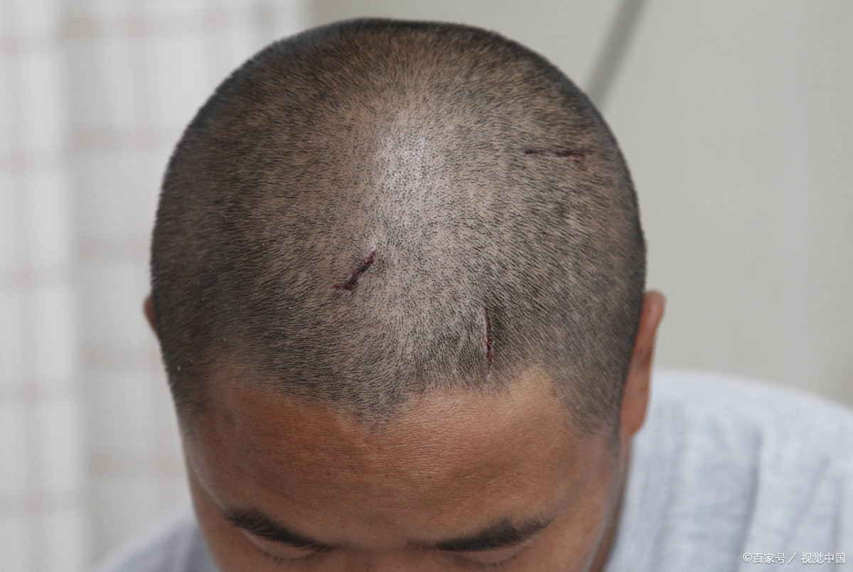 急性颅脑外伤之头皮损伤