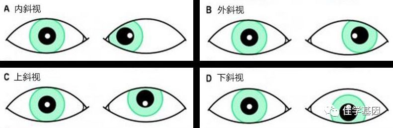 「佳学基因案例」斜视基因检测,基因解码