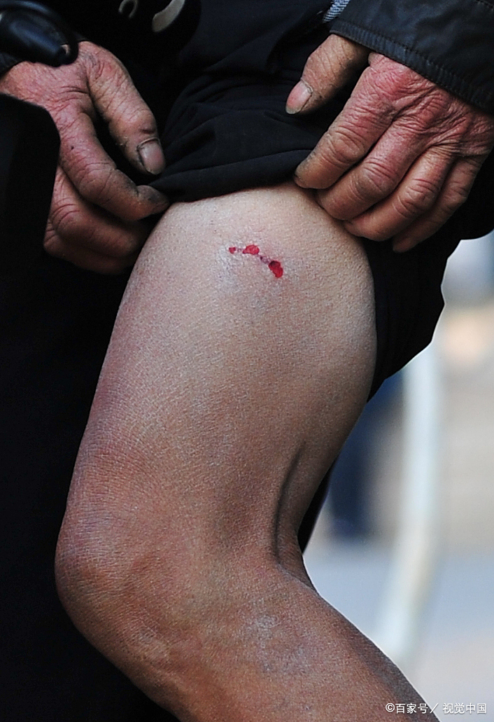 一个才3岁的小天使,竟然因为被恶犬咬伤而永远离开了我们