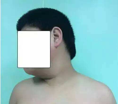 10岁男孩颈部皮肤越来越黑,去医院检查后才知原来是它在作怪