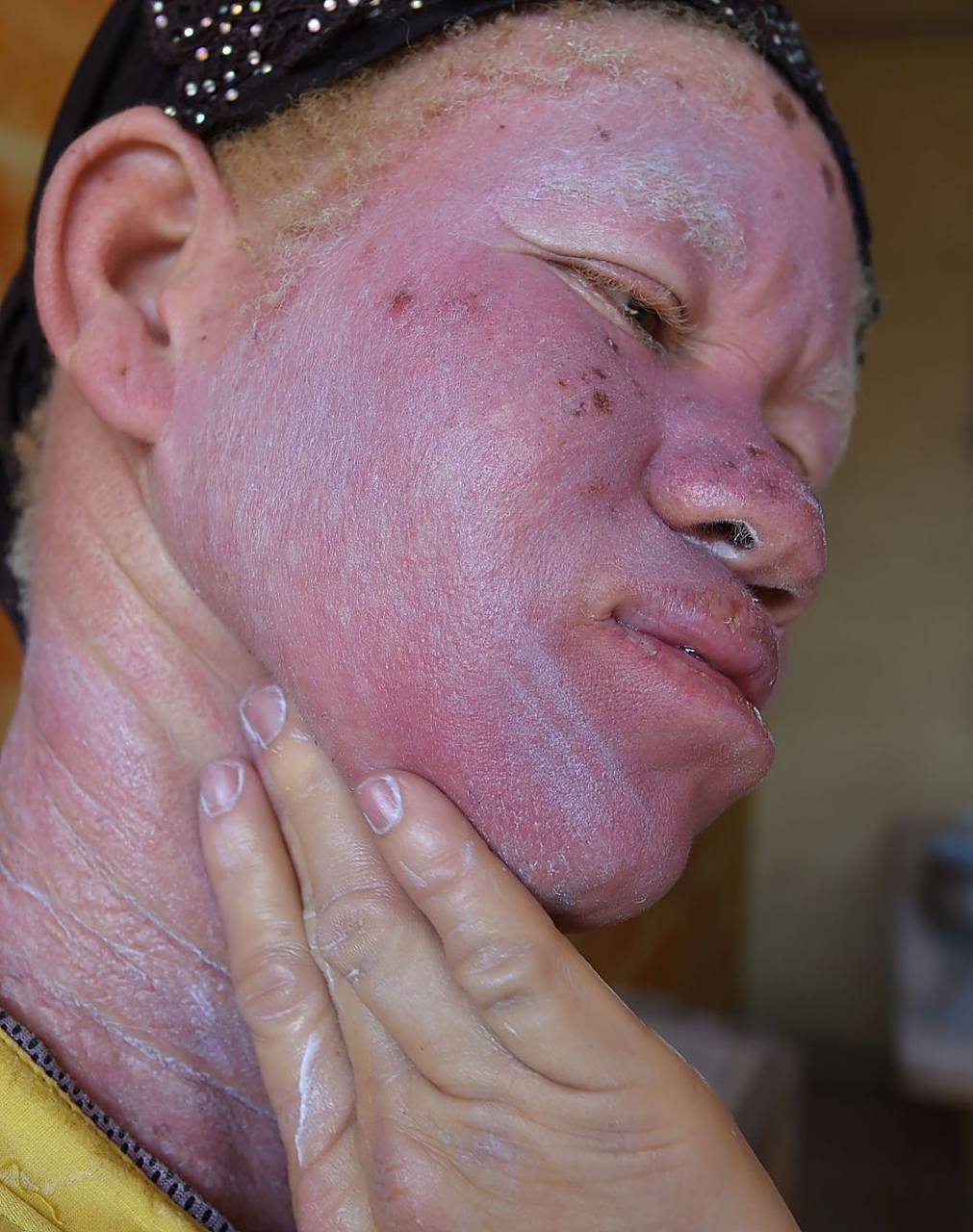 脸部晒伤了怎么快速修复有哪些方法?