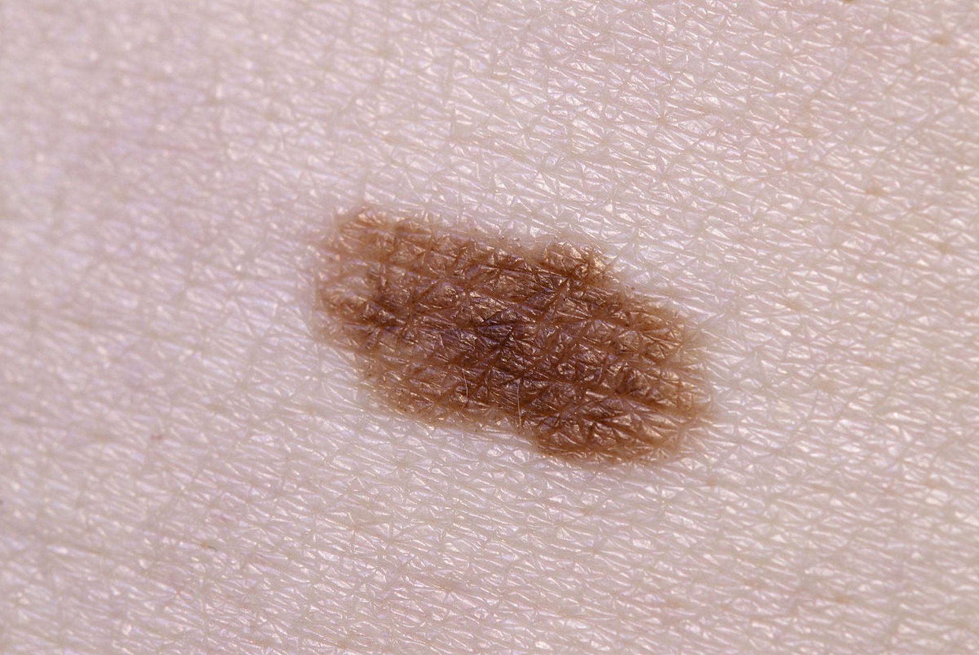 寻常疣#   寻常疣是由人乳头瘤病毒(hpv)引起的.