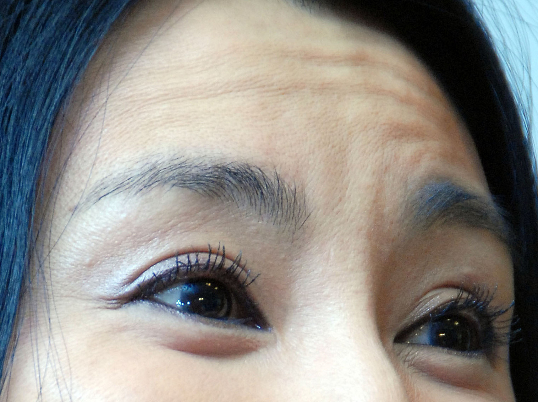 下眼睑下至手术是一种通过手术使下眼皮向下移动的方法,以增加眼球的