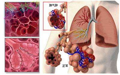 肺气肿的症状图片