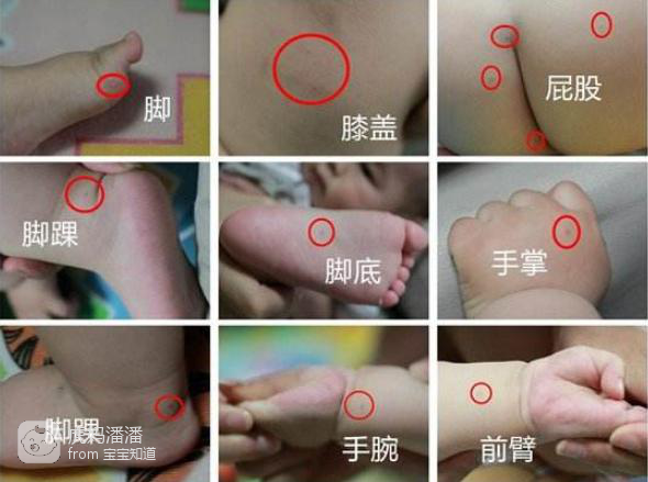 2018是高峰年,"手足口病"究竟怎么判断?怎么护理?