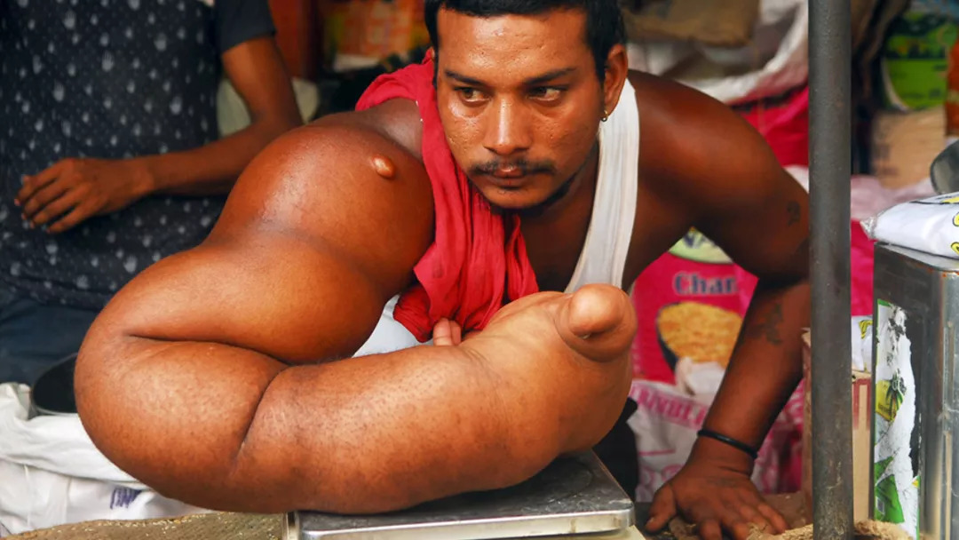 印度男子拥有麒麟臂,一只手臂畸形重40斤,走路只能扛着手臂走!