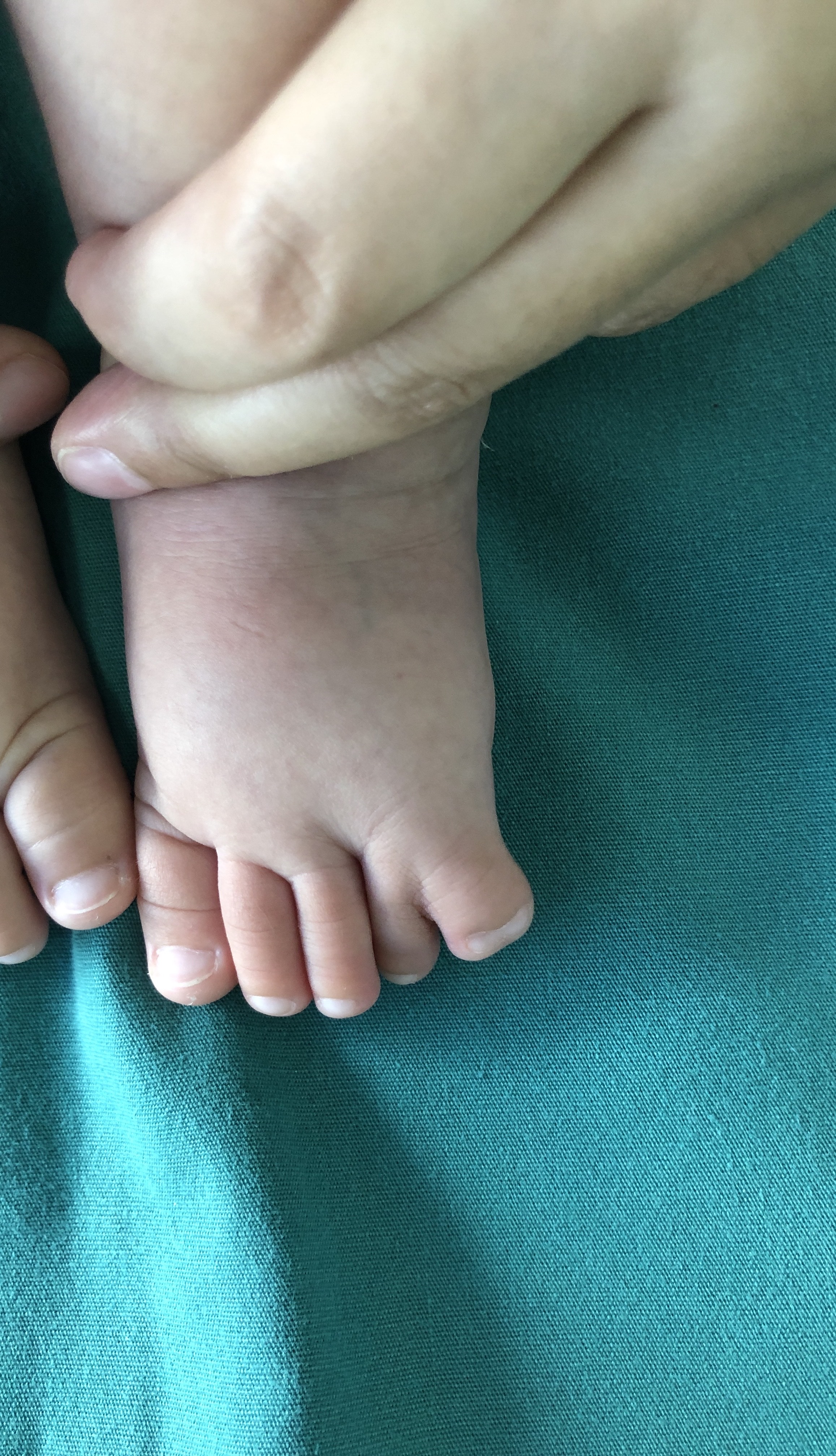 双足小趾多并趾