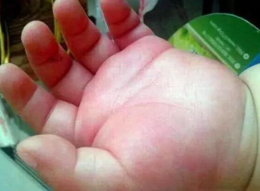 妈妈只出去一天让爸爸带孩子,宝宝就手肿如馒头,检查后狂扇老公