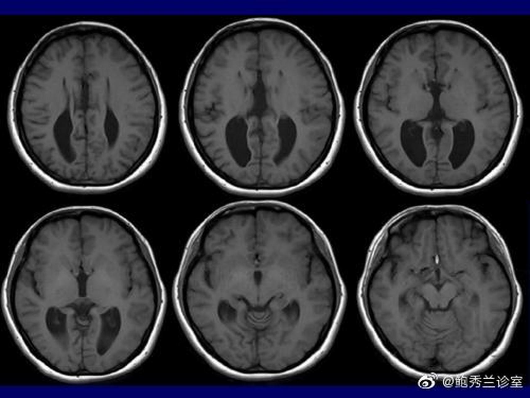 我的萌娃手记##0-3岁育儿经#【宝宝检查胼胝体偏薄,以后会好吗?