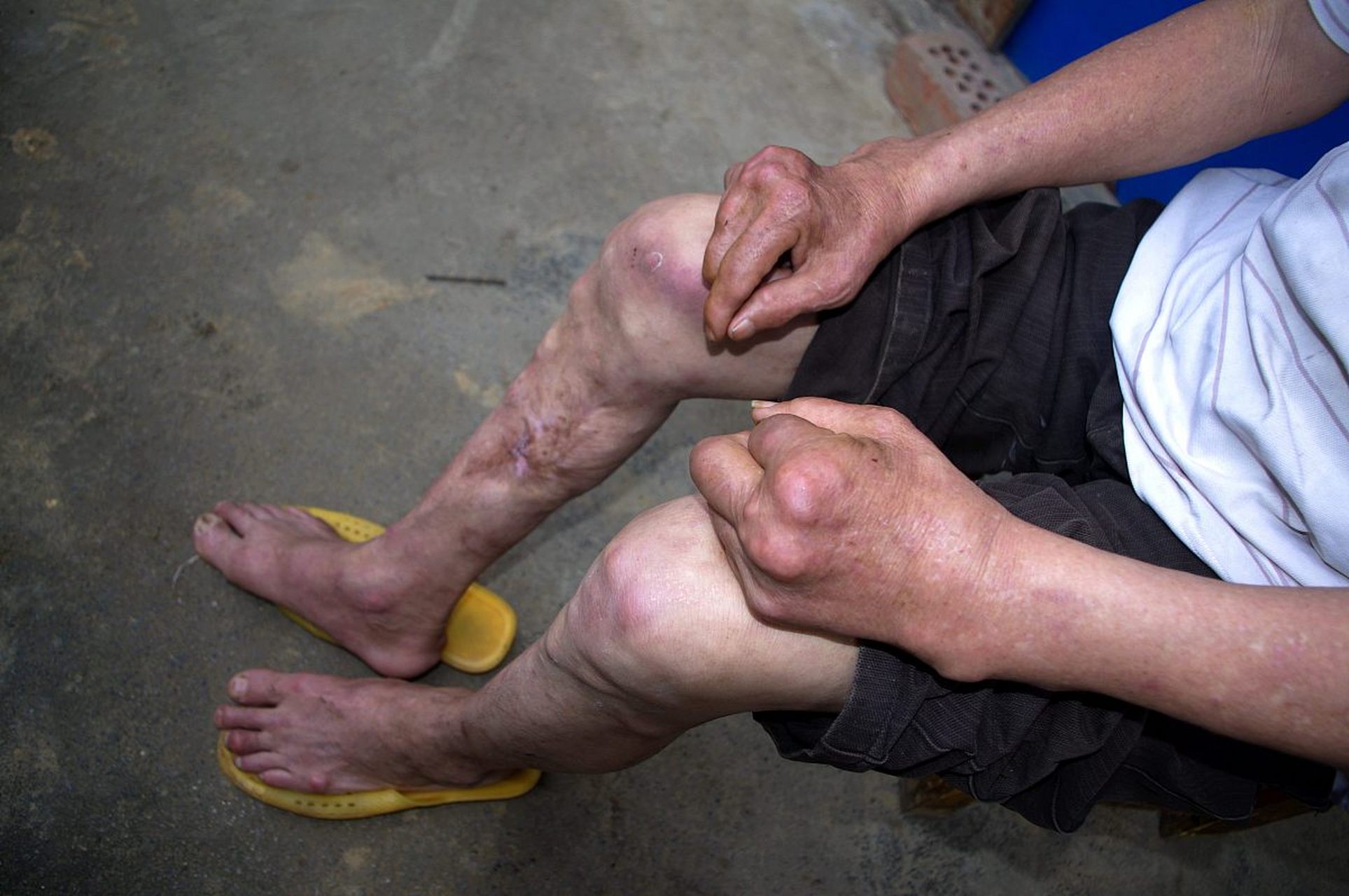 病情越稳定的渐冻症患者,越会重视这"5个治疗的关键因素"!