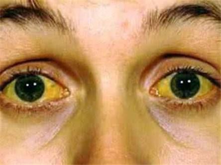 肝脏不好,身体2个部位会发黄,1种食物修复肝损伤,常吃不生病