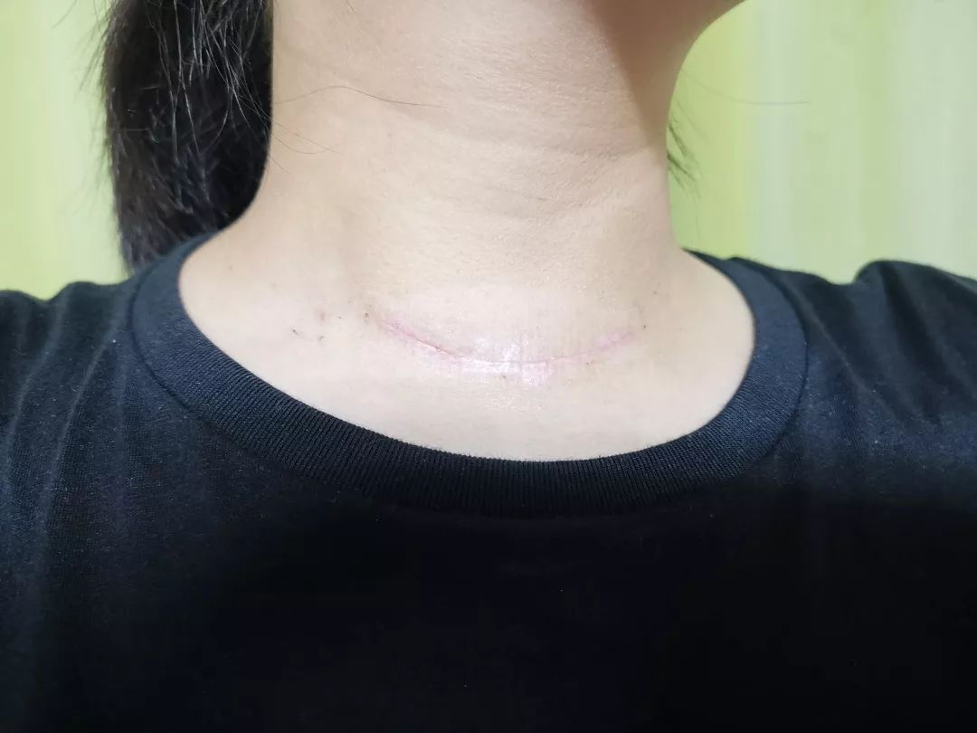 开腹 30 针,穿不了露脐装,还好命还在