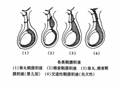 新生儿的睾丸图片图片