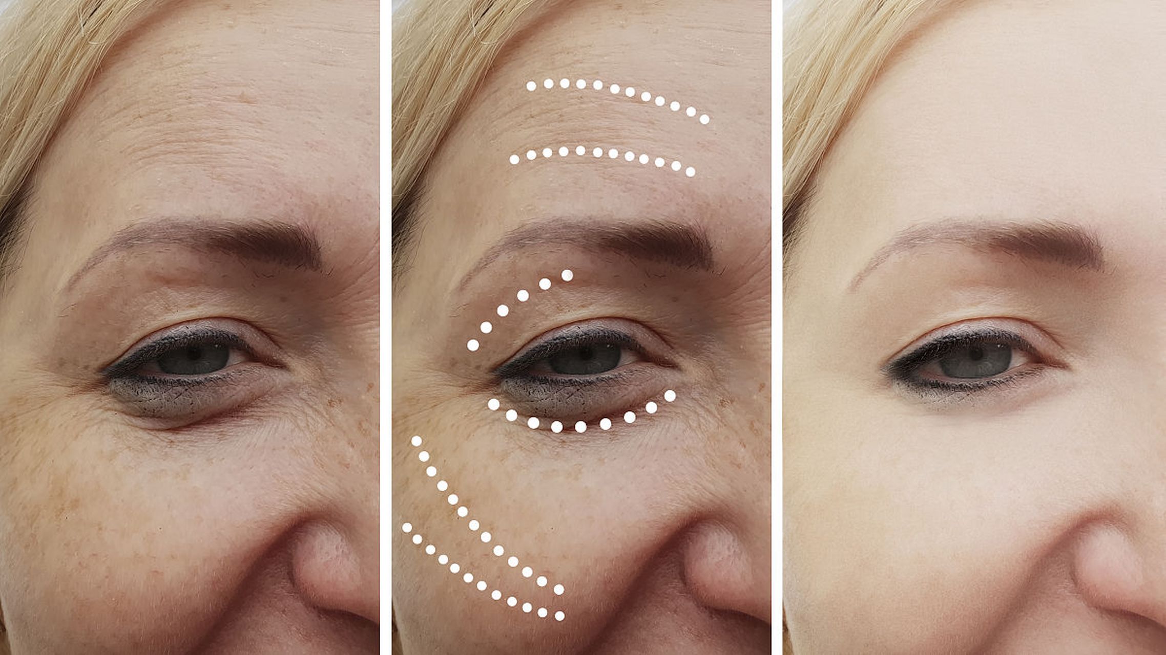 结构型黑眼圈,只能做泪沟填充解决吗?