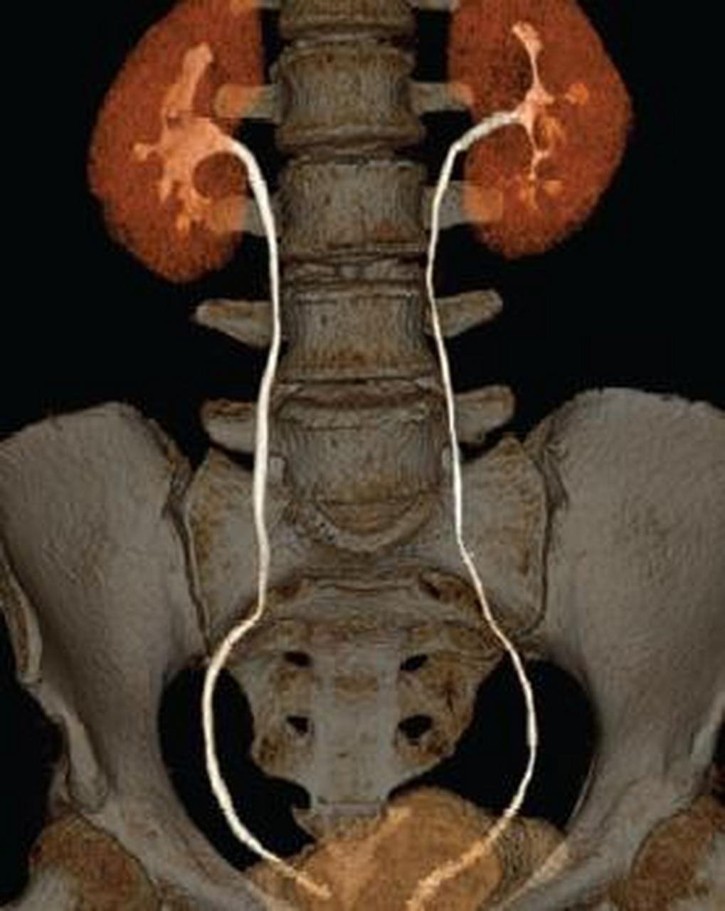 男性泌尿系统解剖图ct图片