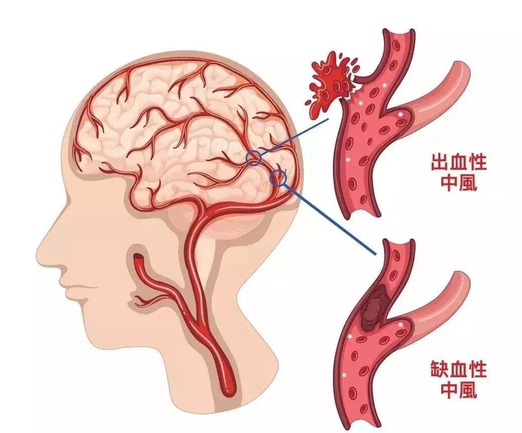 脑梗死里逃生后,中年汉子大喊"再也不敢了!