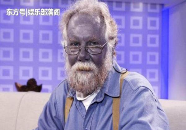 这些奇怪的人真实存在:蓝血人,睫毛2厘米长的人,半个头部的人