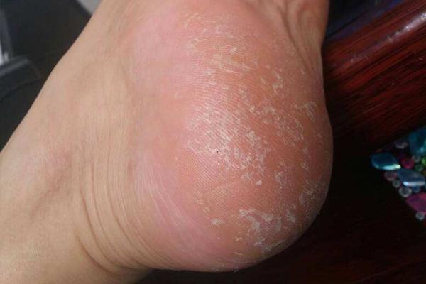 脚上总出现"死皮"?做好这5个护理,脚上又光又亮,厚角质没了