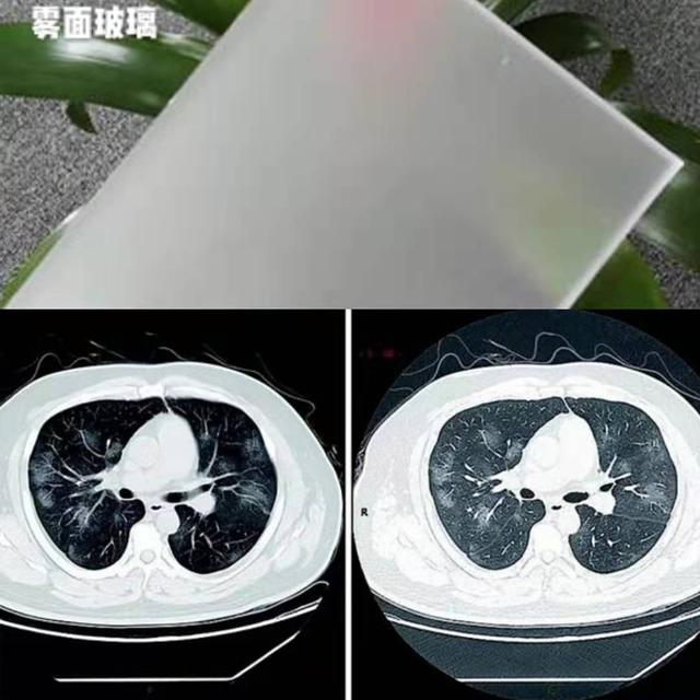 新型肺炎,病情严重会出现"白肺,是什么情况?医生给您讲清楚