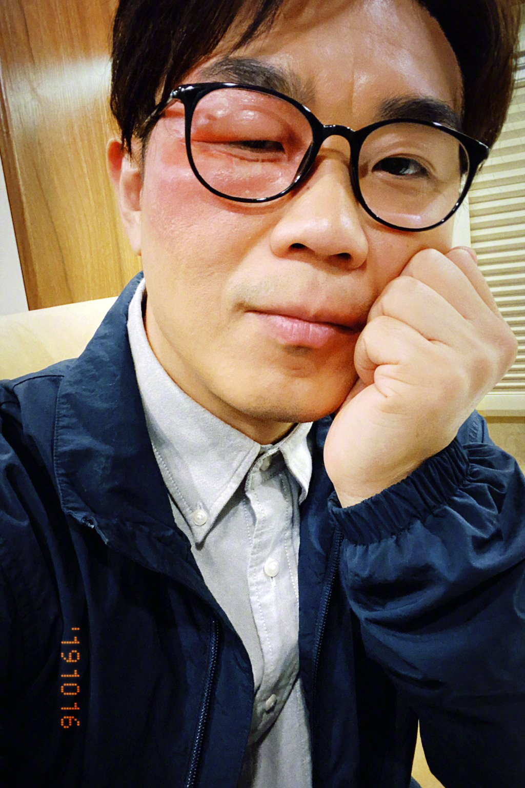 大鹏董成鹏被不明蚊虫咬伤,眼睛红肿异常,右眼睁眼困难