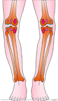 腿弯疼图片