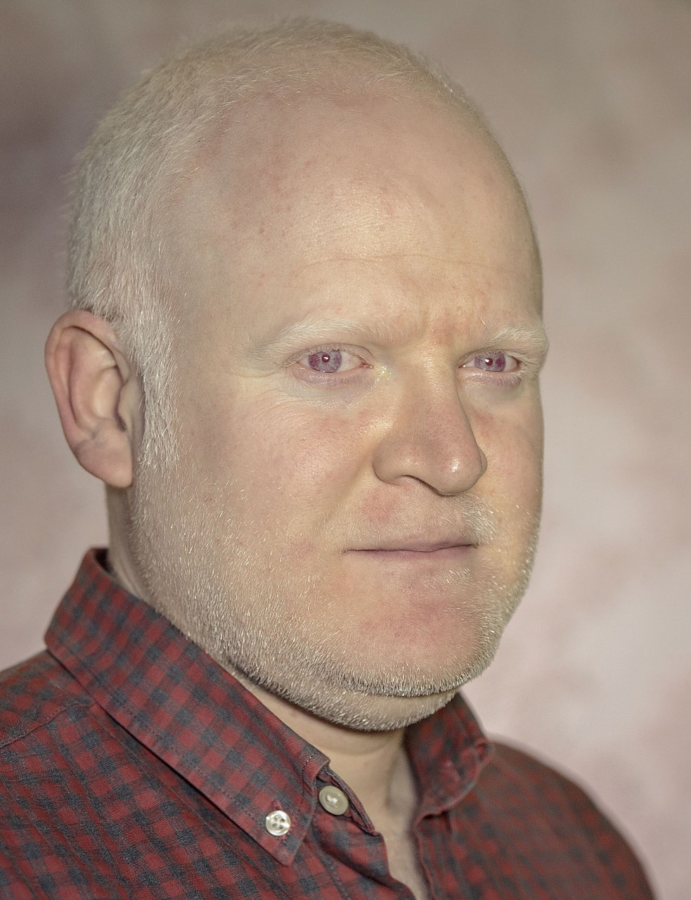 的区分——  白化病是一种【先天性】的色素缺乏病,表现为皮肤,眉毛