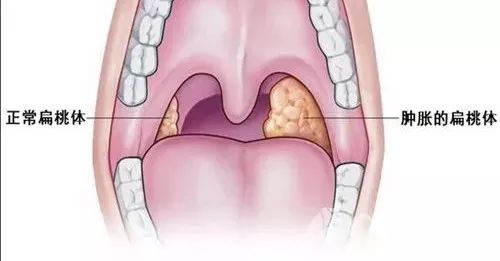嗓子两边扁桃体像蜂窝图片