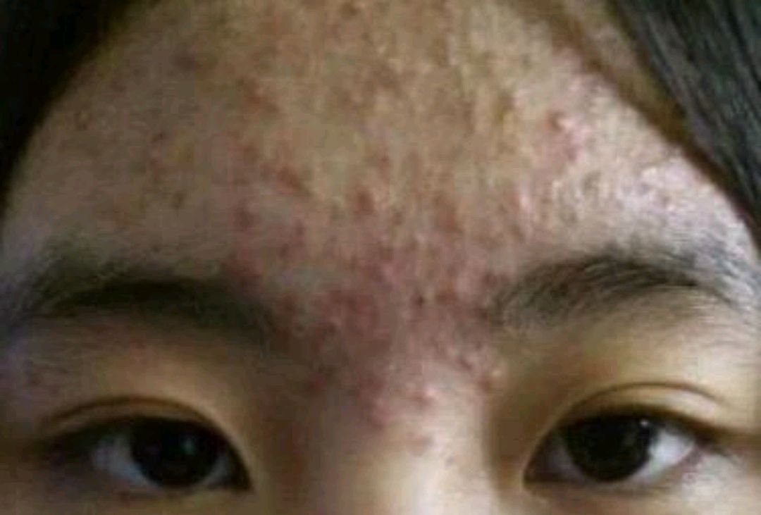 调理体质,告别痘痘,还女神春季同款清爽脸!