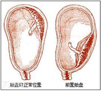 胎盘附于子宫前壁图片
