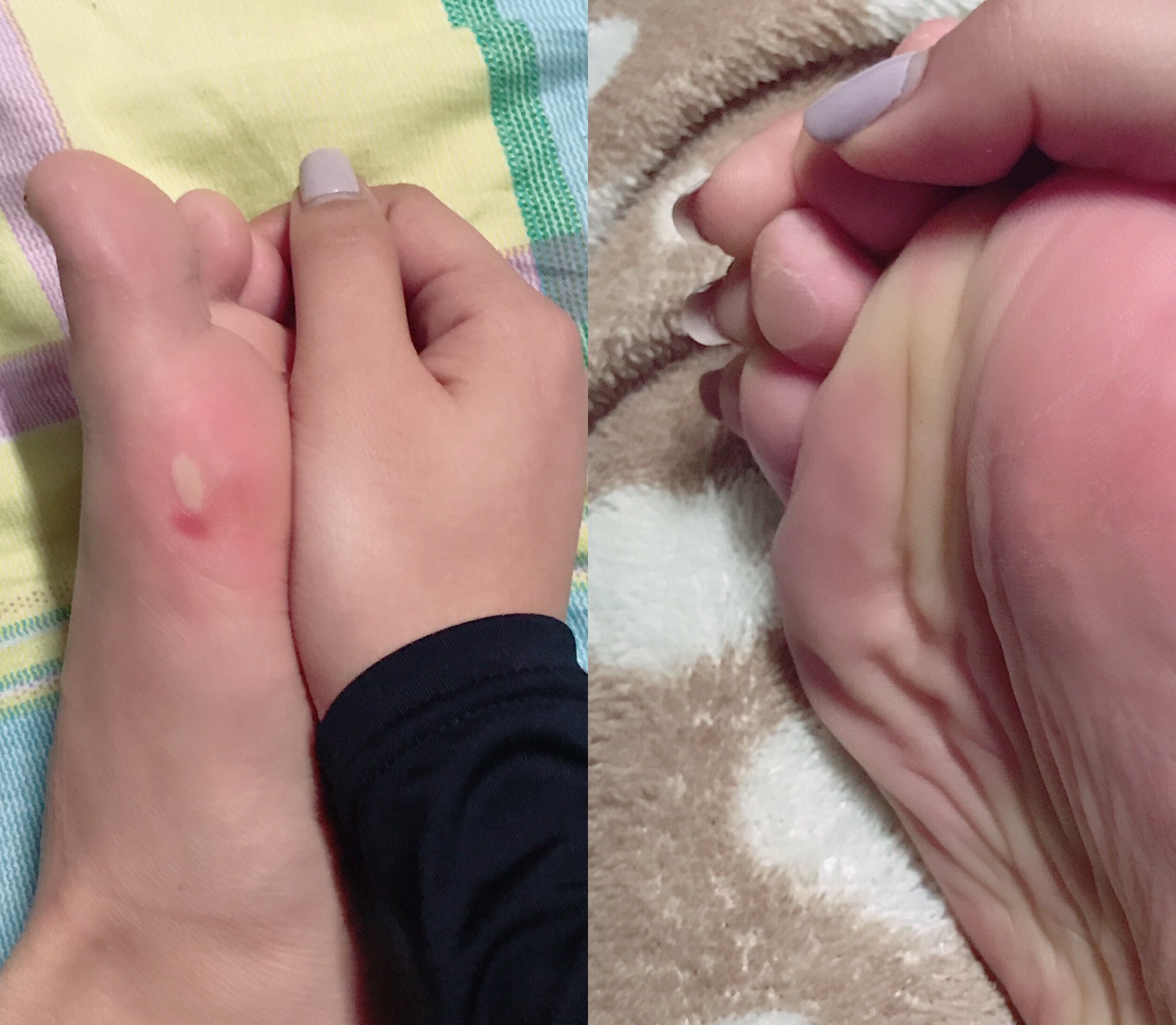 小水泡误事,不正确的水泡处理方式影响跑步训练