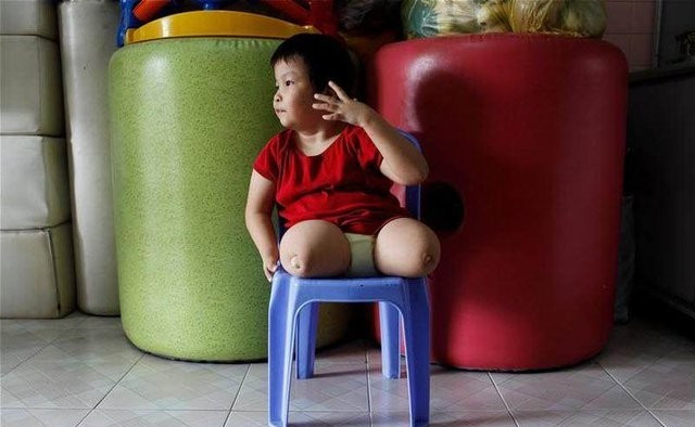 越战时美军种下的恶果,单眼双鼻,三头六臂的孩子随处可见