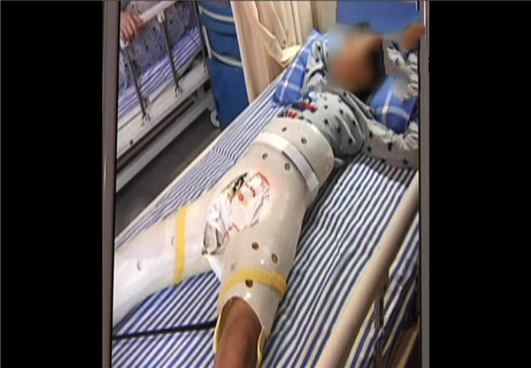 六年级男孩学校踢球骨折,母亲愤怒要求赔偿,校方是否存在责任?