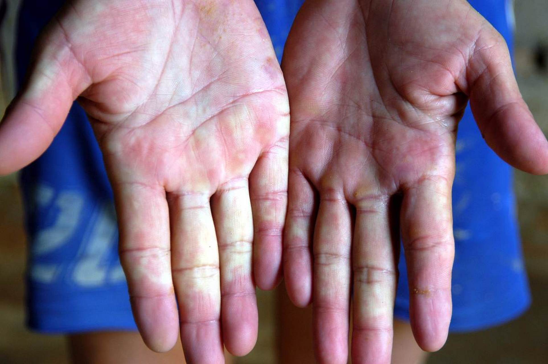 手掌上有白色斑点是什么原因?