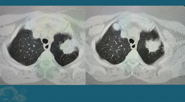 肺癌手术后要不要化疗?她1年后复发,靠1种靶向药活了7年