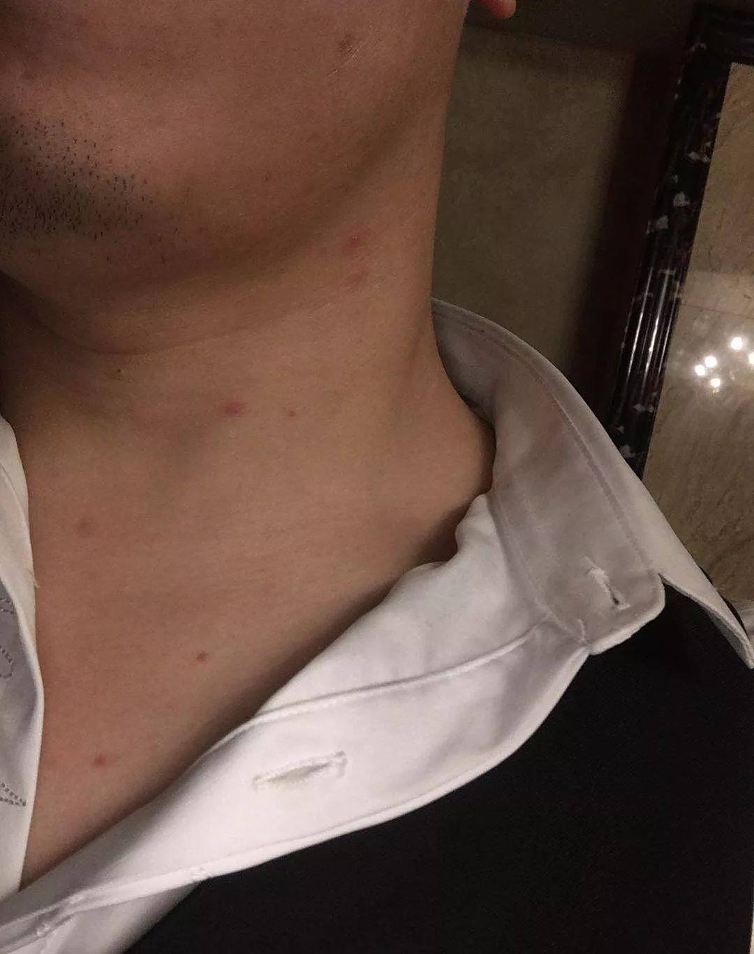 hiv/艾滋病药物皮疹