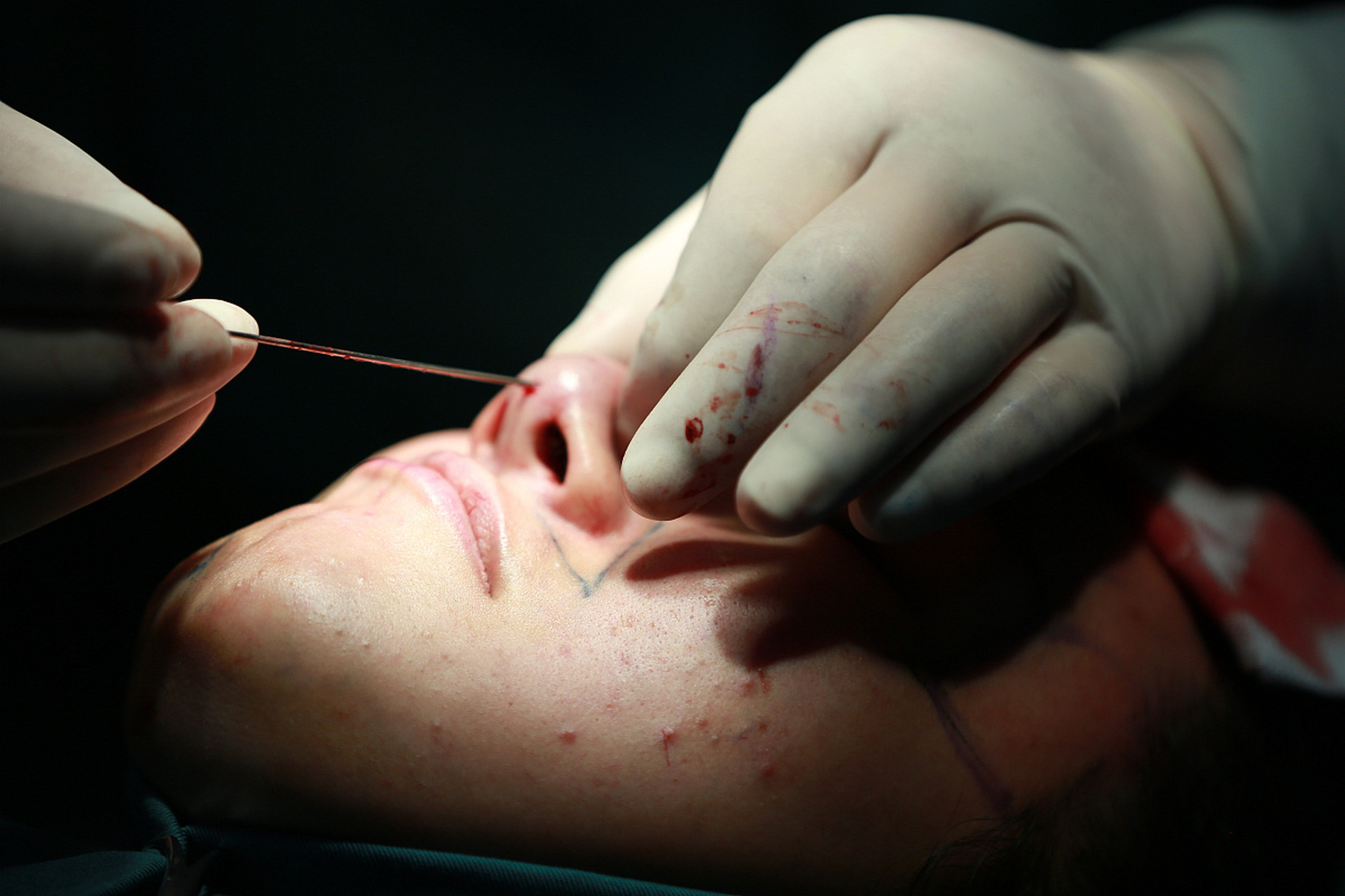 线雕鼻的线吸收时间因个体差异而异,一般需要数周至数月的时间.