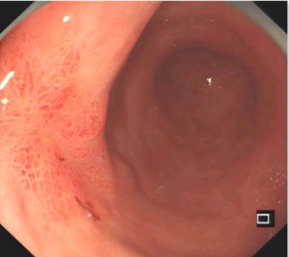 胃镜下早期胃癌图片图片