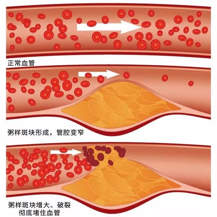 一旦血管发生堵塞,就会容易导致血流不畅,从而引发心脑血管疾病,严重