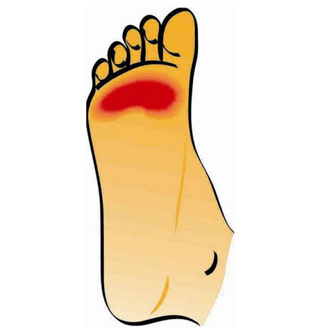 莫顿神经瘤的症状和病因是什么?