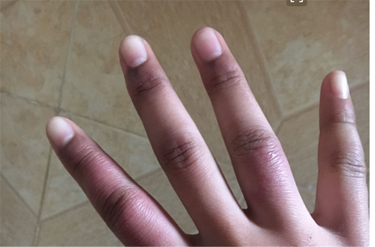 第四种情况: 手指头变粗 有的慢性肺部疾病会导致手指头变粗,用比较