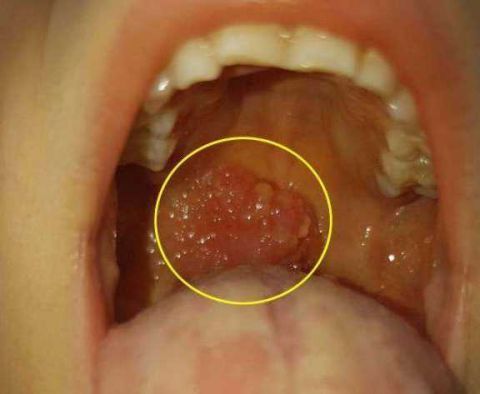 口咽有疙瘩图片图片