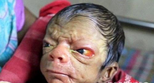 真实版的"返老还童"?婴儿刚出生就像老头,父母却称为奇迹