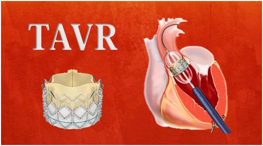 高危主动脉瓣狭窄福音!这种新技术可为tavr手术"保驾护航"