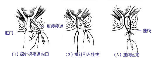 肛瘘是什么?怎么治疗?
