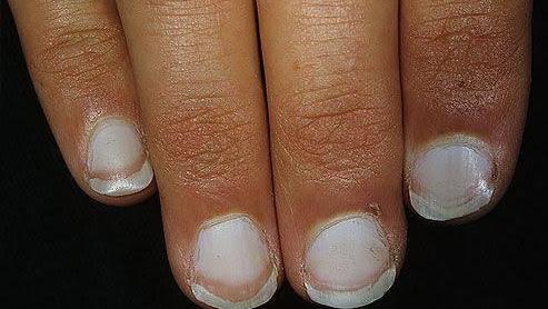 接近25%的肝病患者出现这种手指改变,医生给您讲下啥是特里指甲