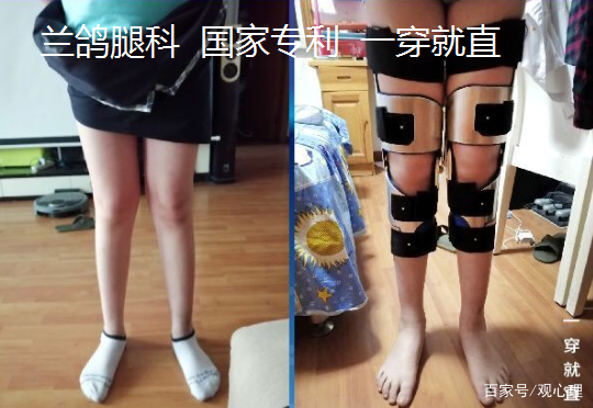 矫正o型腿