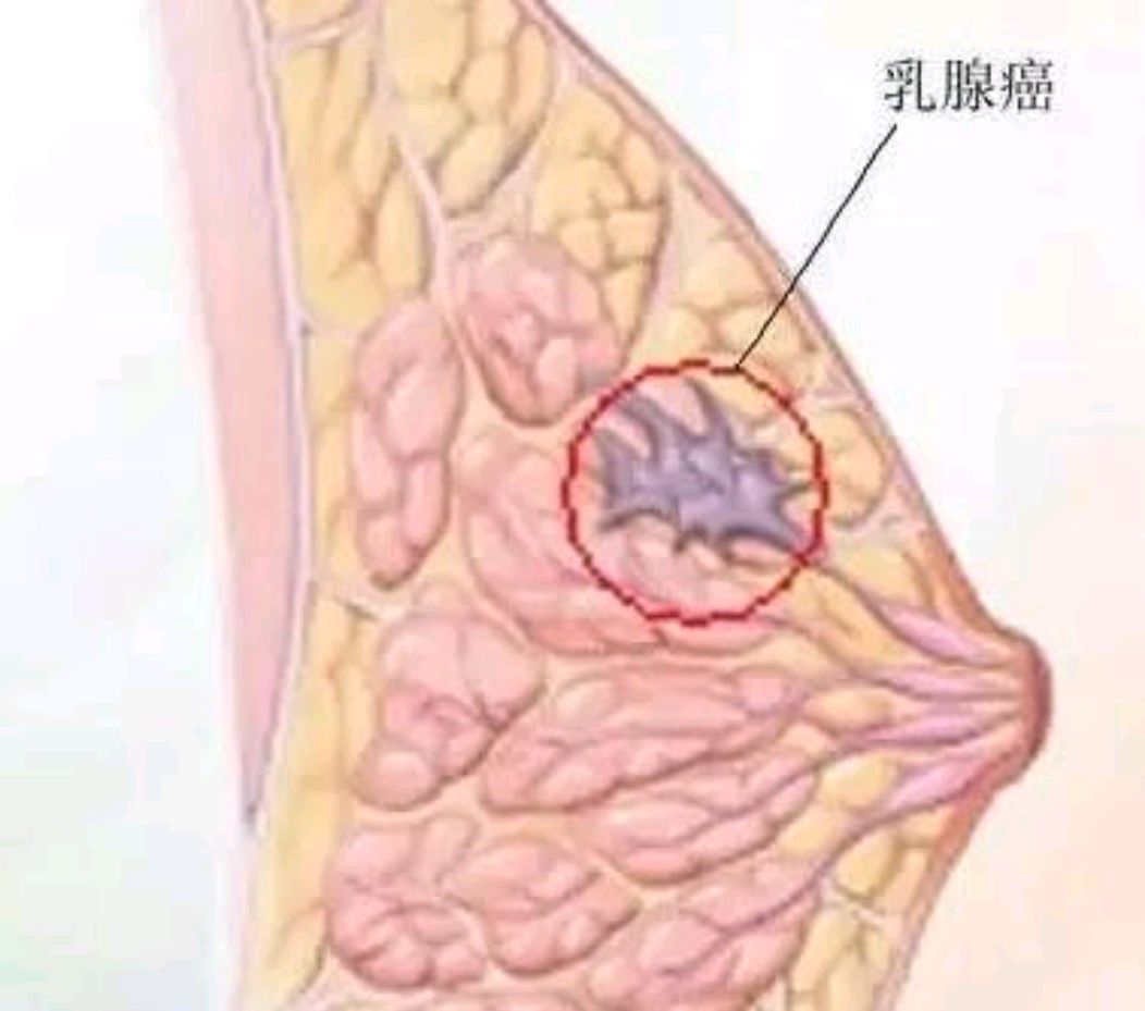 真实乳腺癌的前兆图片图片