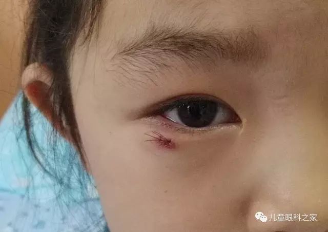 儿童常见眼肿物之钙化上皮瘤