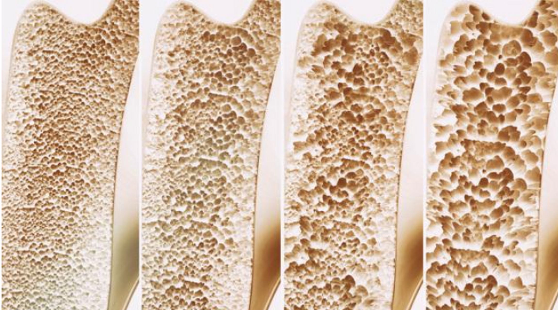 这是一种全身代谢性骨病,以骨量减少和骨骼强度下降为主要特征,多发生