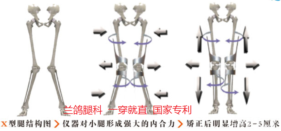 矫正o型腿